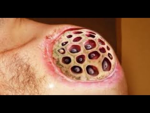 blackhead removal