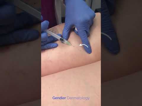 Sclerotherapy I Gendler Dermatology