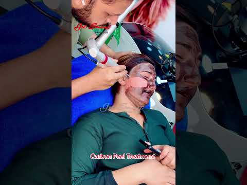 Carbon peel Laser #getsmarthairclub #viralvideo #love #laserhairremoval