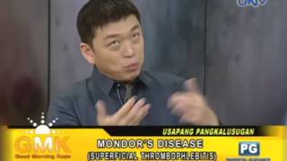 Mondors disease (Mondor's Syndrome of Superficial Thrombophlebitis)