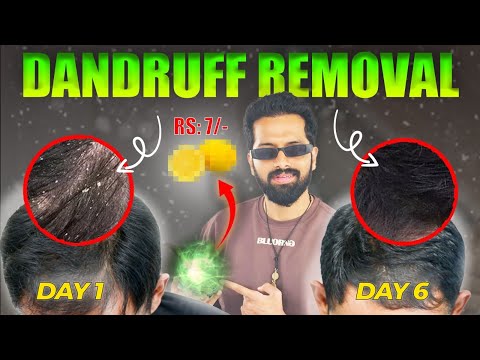 Click Here- 5 DANDRUFF Home Remedies (Fully natural) #hair #mentransformation