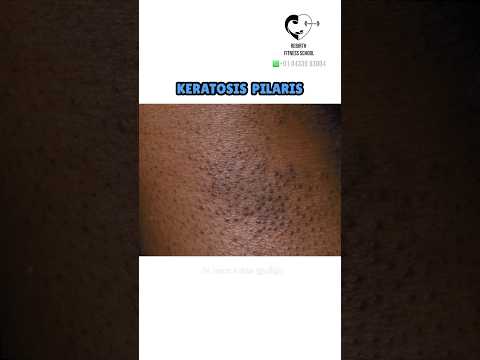 Dark bumps on skin (Keratosis pilaris)-   Dr. Isacc Abbas