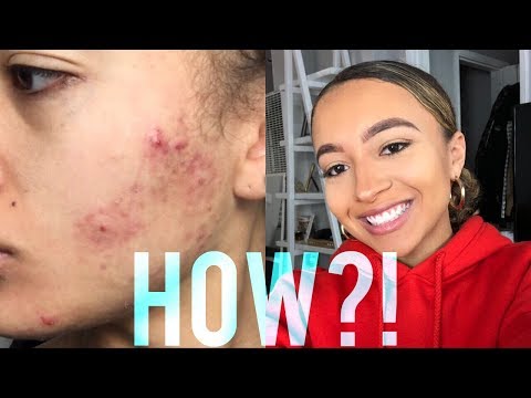 HOW TO GET CLEAR SKIN // NO MORE ACNE