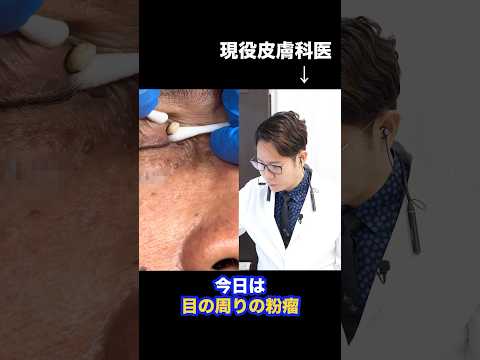 Japanese Dermatologist's Impressions on an Atheroma: A Very Rough Procedure Video