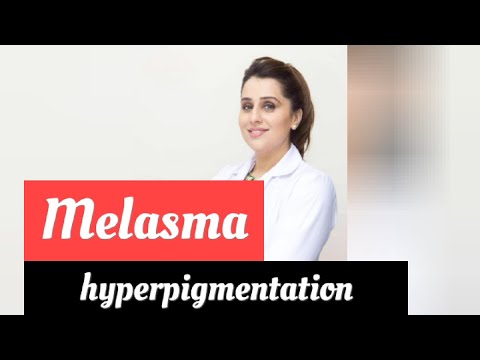 how to get rid of melasma !hyperpigmentation ! acne! spot