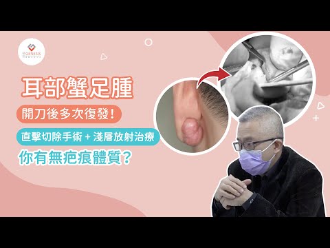 【手術室直擊】疤痕體質令蟹足腫開刀後多次復發｜蟹足腫放射治療過程｜耳洞蟹足腫如何處理？｜健康蘋台