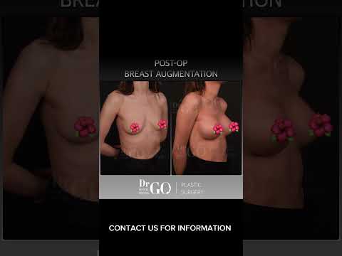 Before and After Breast Augmentation - Dr Guncel Ozturk #guncelozturk #drgo