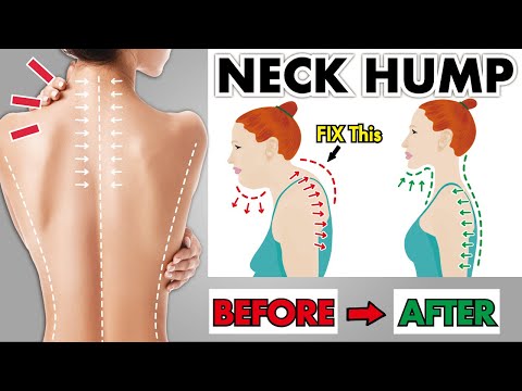 How to Fix Neck Hump and Slim Face with EASY Exercises (Subtitle)