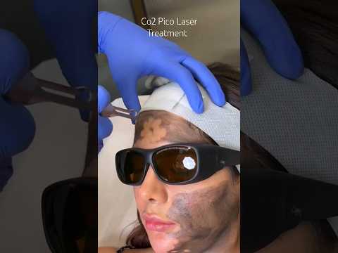 Co2 Pico Laser Treatment  at CARA