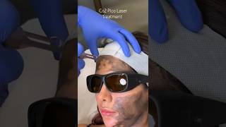 Co2 Pico Laser Treatment  at CARA