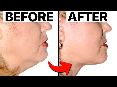 How To Get a Jawline without Skin Removal