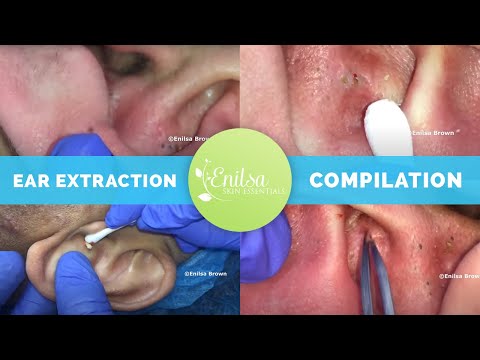 Ear Extraction Compilation