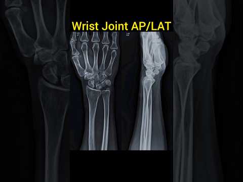 Wrist Joint X ray