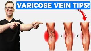 Best Varicose Vein Home Treatments! [Top 25 Spider Veins Remedies]