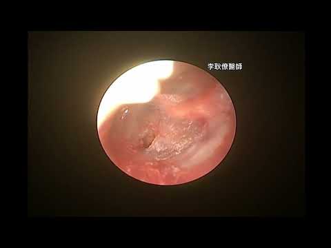 中耳炎 中耳腔積水 聽力障礙 通氣管置入 Ventilation Tube Insertion for Middle Ear Effusion