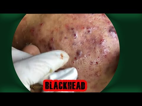 The Pimple Remove - Popping Videos - Blackheads 2019 #18