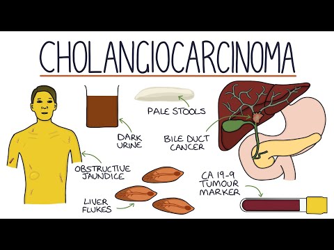 Understanding Cholangiocarcinoma