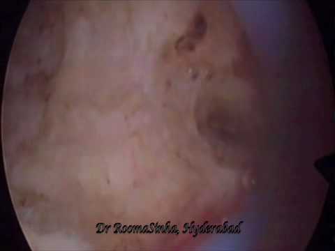 Hysteroscopic septal resection B.mp4