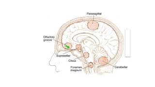 Meningiomas: Signs, Symptoms and Advanced Treatment Options