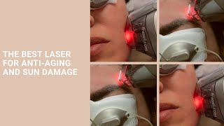 The Best Laser For Anti-Aging And Sun Damage: Fraxel