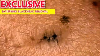 Satisfying Relaxing With Poppy Tv Blackhead Removal