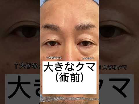 目の下の鬼グマなくなった！