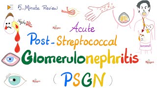 Acute Post-Streptococcal Glomerulonephritis (APSGN) -Nephritic Syndrome -Kidney Pathology-Nephrology