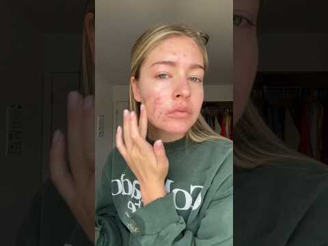 GRWM for my birthday #acne #accutane #grwm