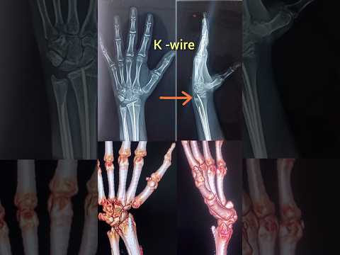 K-Wire & X ray 🆚3D