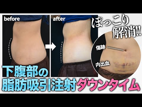 【腹部 脂肪吸引注射のダウンタイム】ぽっこり下腹を改善！圧迫固定なし＆日常生活ほぼ支障なしで簡単お腹痩せ！内出血・傷跡・拘縮などダウンタイムを細かくレポート！