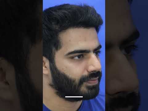 Amazing Transformation at MedLinks | Best Hair Transplant Result #shorts #shortsfeed