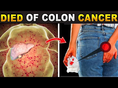 👉 THIS Is Why YOUNG People Are Dying Of COLON CANCER! ⚠️  -  Healthy lifestyle