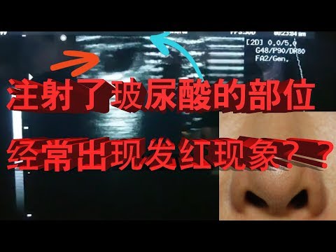 注射玻尿酸后經常會出現發紅或發青發紫現象的原因和診斷方法