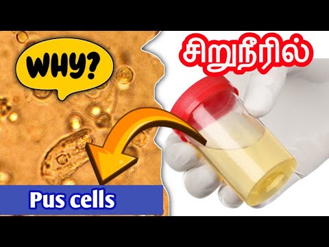 Pus cells in urine explained in tamil | சிறுநீரில் pus cells காணப்படுவது ஏன்? | STAR LABORATORY