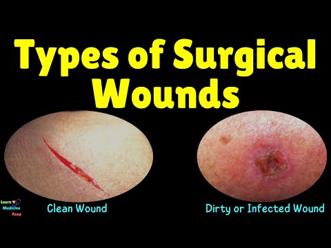 Types of Surgical Wounds | Surgical Wound Classification