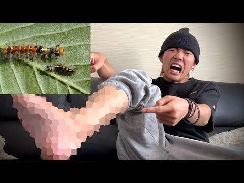 【閲覧注意】毒毛虫に刺されるとこうなります