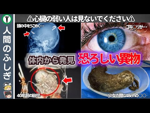 体内から発見された信じられない異物【ゆっくり解説】