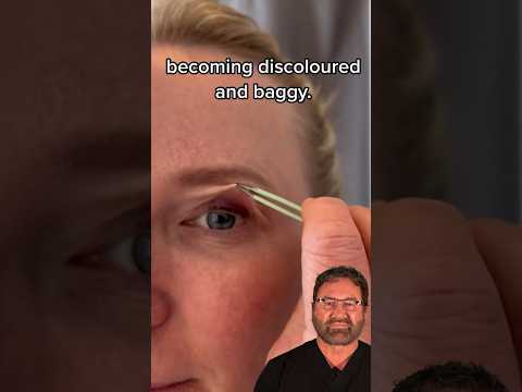 Thin Baggy Eyelid Skin - Surgeon Reacts