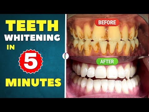 Teeth Whitening at Home (100% effective) | Teeth whitening products | Professional teeth whitening