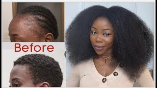 My natural hair journey. Hair loss, Balding, Damage and Regrow + pics and videos