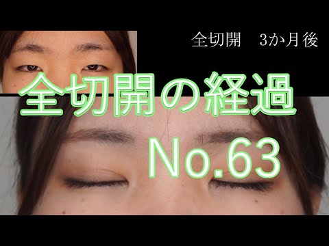 全切開二重手術　63　　20代女性