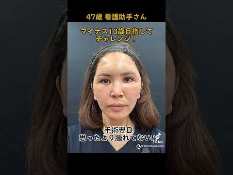 47歳看護助手、人生初の若返り手術でマイナス10歳目指します。目標達成なるか⁉️ #ジェントル滝澤 #湘南美容外科 #眉下リフト