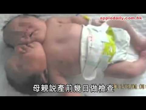 巴西孕婦 產罕見雙頭連體男嬰 - 醫生無法分離