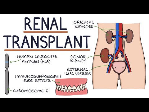 Understanding Kidney Transplants