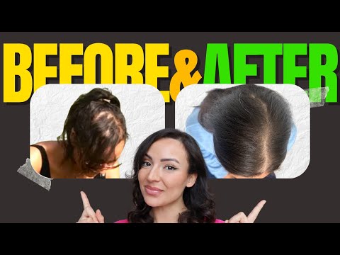 How I Reversed Hair Loss in 1 Year: Proven Tips for Thicker, Healthier Hair!