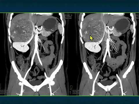 CT of the Large Adrenal Mass: Follow, Biopsy, Resect - Part 2