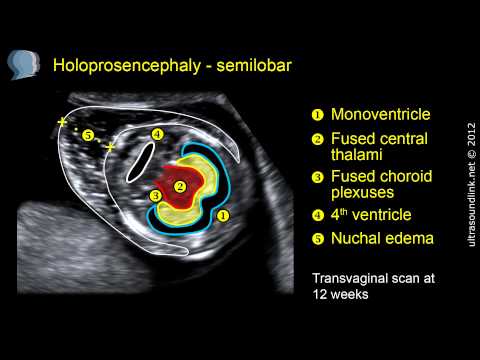 Semilobar holoprosencephaly: 2D and 3D ultrasound