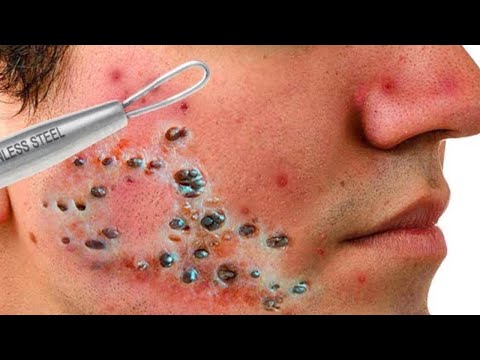 Popping huge blackheads on all over the face newest 2021 , pimple popping