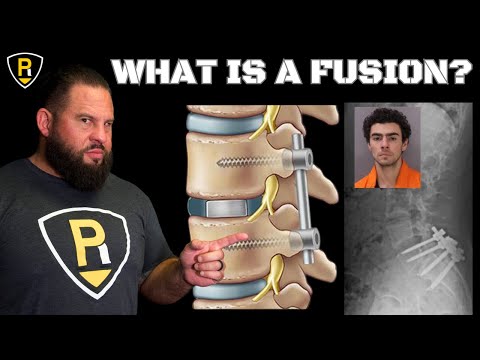 SPINAL FUSION (What Is It?)