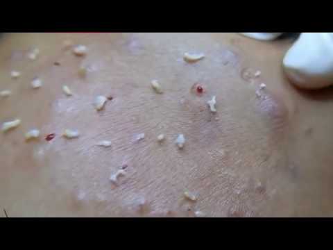 Alot of Whiteheads Removed By Exert, Skill Acnes Remove 2019, Milia